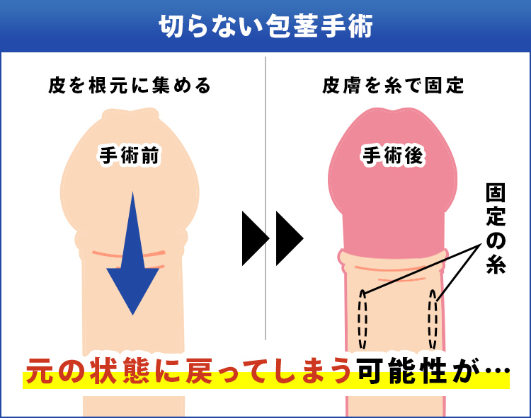 切らない包茎手術　皮を根元に集める　皮膚を糸で固定　元の状態に戻ってしまう可能性が…