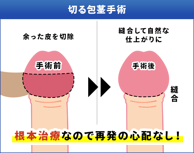 切る包茎手術	余った皮を切除	縫合して自然な仕上がりに　根本治療なので再発の心配なし！